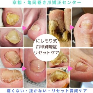 巻き爪矯正を京都や向日市でお探しなら 京都 向日市巻き爪矯正センター 巻き爪矯正を京都や向日市でお探しなら 京都 向日市巻き爪矯正センター